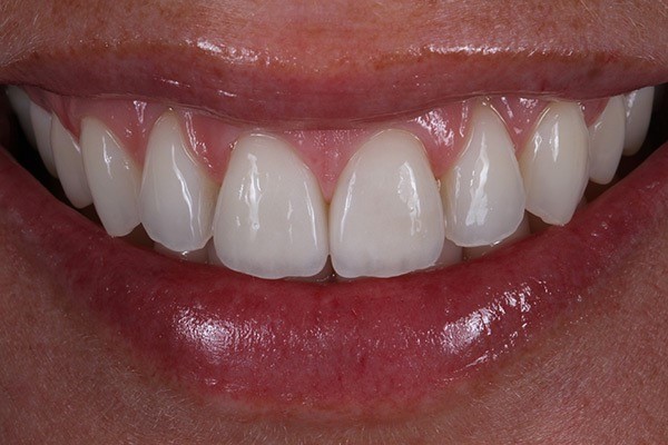 gingivoplastika